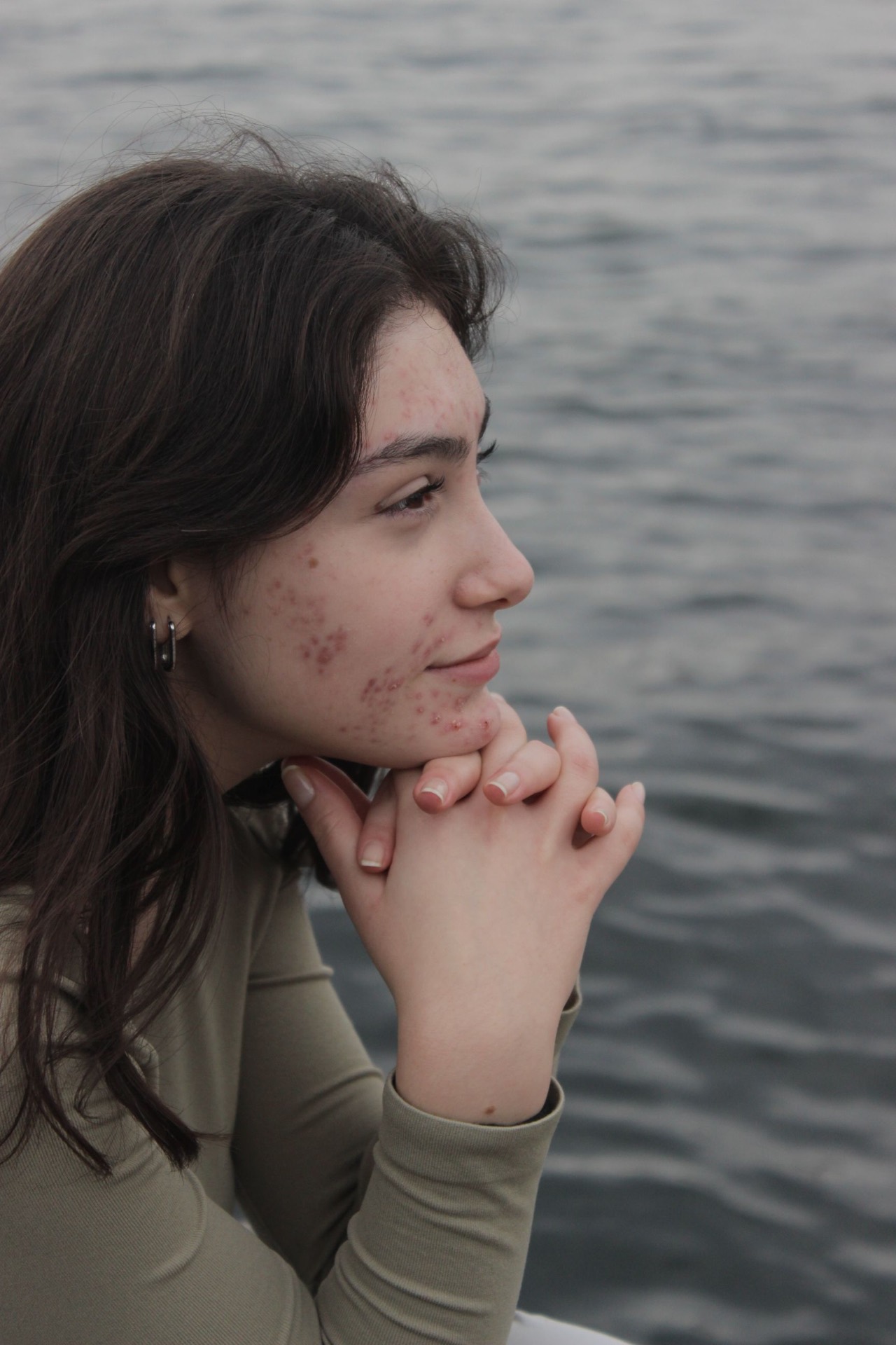 stubborn acne scars