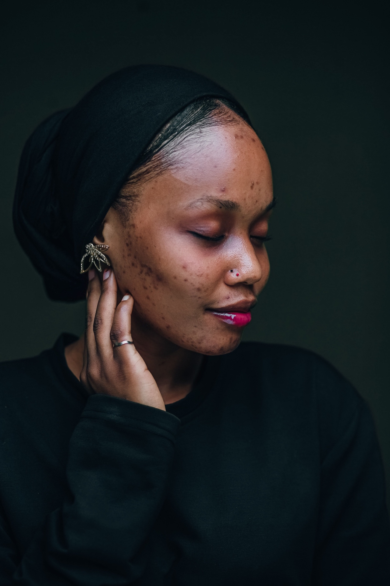 Hyperpigmentation After Acne