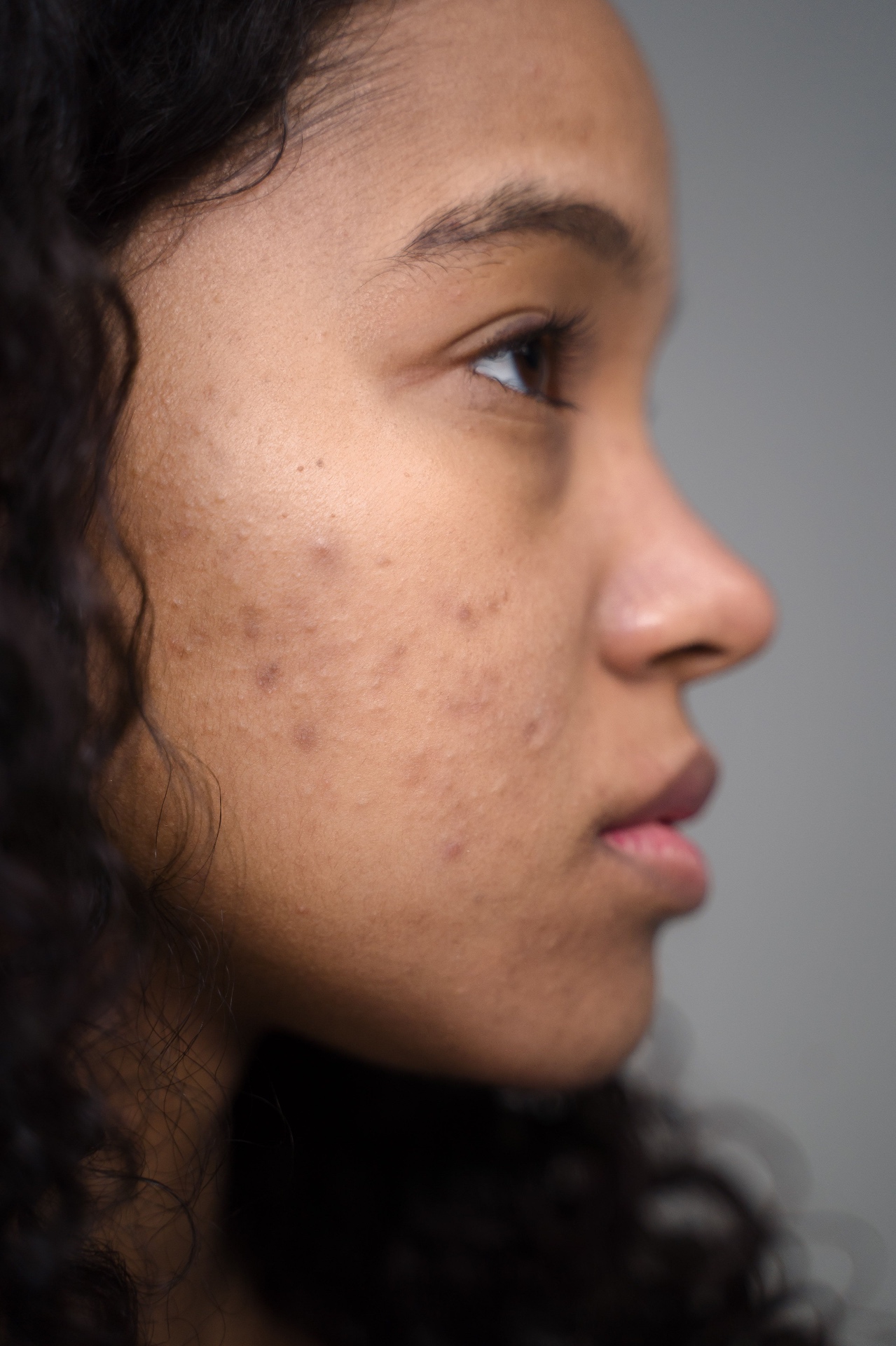 Best Treatment for Hyperpigmentation on Black Skin